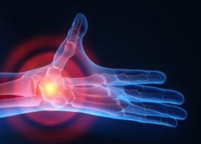 3D rendered photo of rheumatological disease affecting the hand